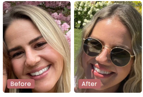 Before and after